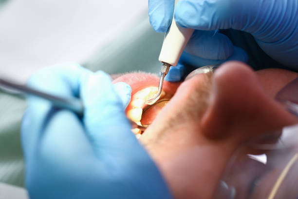 Best Emergency Dentist for Lost Fillings or Crowns in Oak Park, IL